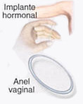 Implante hormonal/ Anel vaginal
