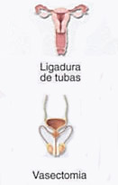 Ligadura de tubas / Vasectomia